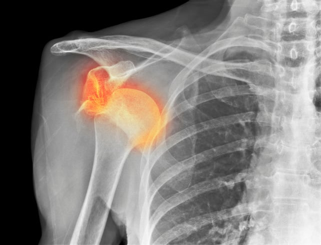 Dislocated shoulder. Coloured X-ray of a 77 year old female patient with a dislocated shoulder.